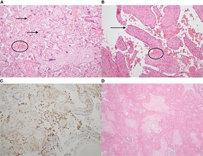 Chronic Inflammatory Placental Disorders Associated With Recurrent Adverse Pregnancy Outcome